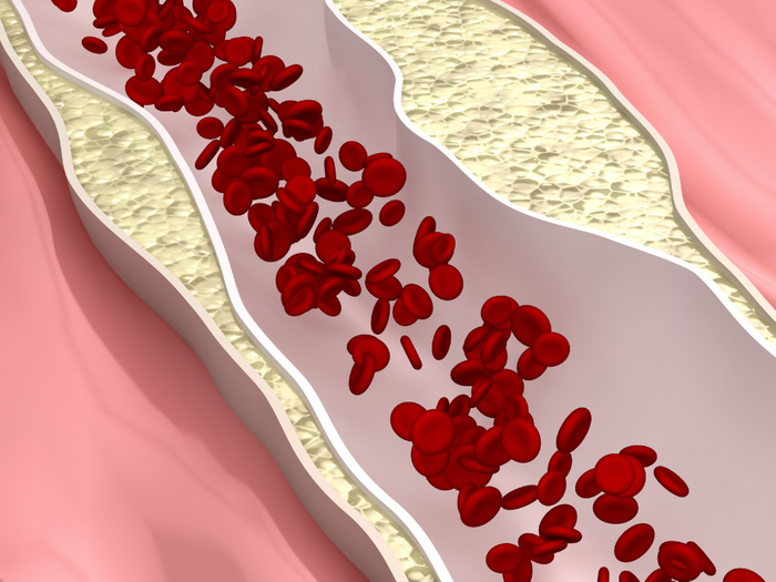Nämä asiat tekisin alentaakseni korkeaa kolesterolia