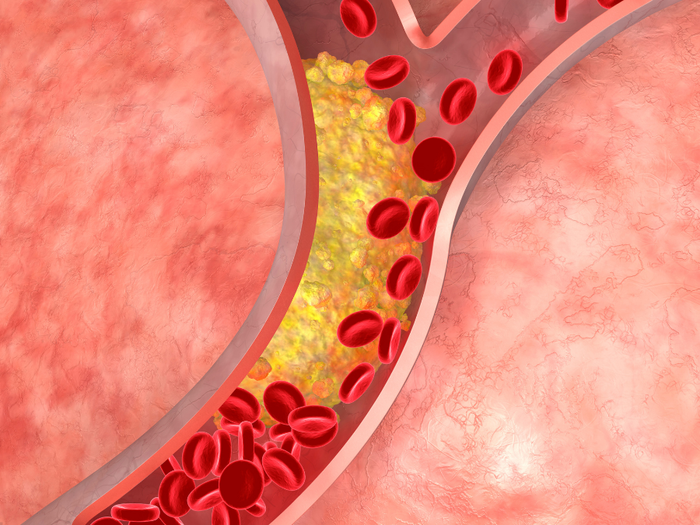 Kolesterolilääke, joka ei aiheuta lihaskipuja: Kolesterolin hoito ilman lääkitystä